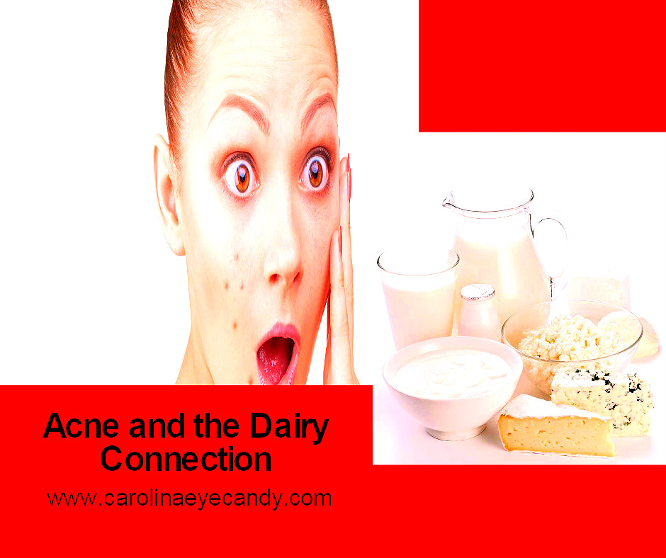 Acne and Its Dairy Connection