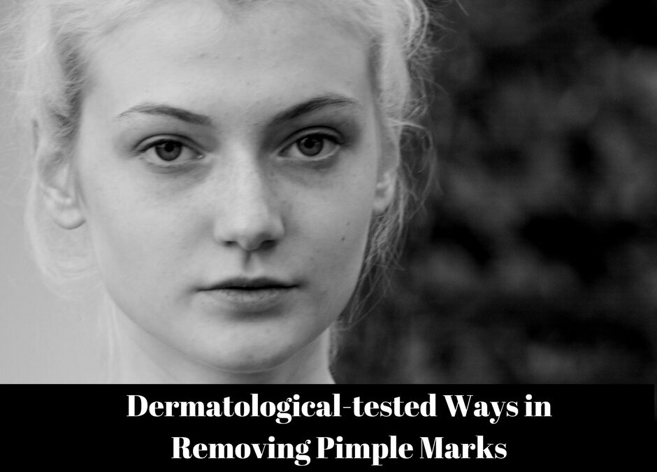 Dermatological-tested Ways in Removing Pimple Marks